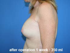 plastic-surgery-breast-augmentation 