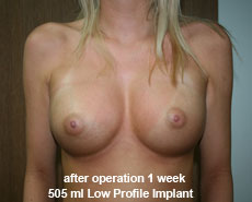 plastic-surgery-breast-augmentation 