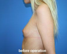 plastic-surgery-breast-augmentation 