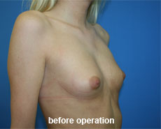 plastic-surgery-breast-augmentation 