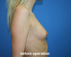 plastic-surgery-breast-augmentation 