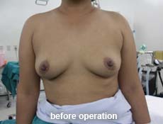plastic-surgery-breast-augmentation 