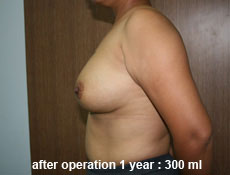 plastic-surgery-breast-augmentation 