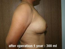 plastic-surgery-breast-augmentation 
