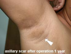 plastic-surgery-breast-augmentation 
