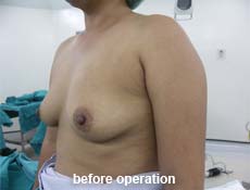 plastic-surgery-breast-augmentation 