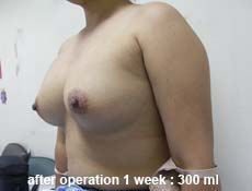 plastic-surgery-breast-augmentation 