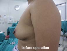 plastic-surgery-breast-augmentation 