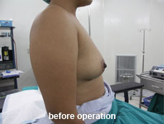 plastic-surgery-breast-augmentation 