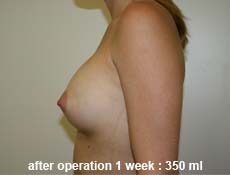 plastic-surgery-breast-augmentation