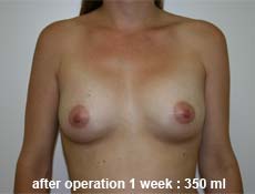 plastic-surgery-breast-augmentation