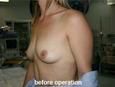 plastic-surgery-breast-augmentation