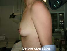 plastic-surgery-breast-augmentation