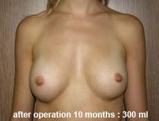 plastic-surgery-breast-augmentation