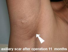 plastic-surgery-breast-augmentation