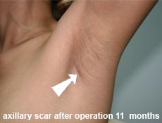 plastic-surgery-breast-augmentation