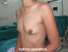 plastic-surgery-breast-augmentation