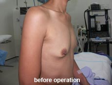 plastic-surgery-breast-augmentation