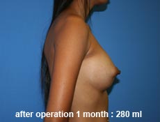 plastic-surgery-breast-augmentation