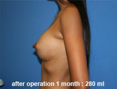plastic-surgery-breast-augmentation