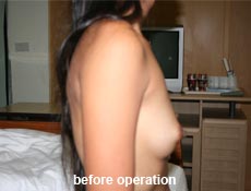 plastic-surgery-breast-augmentation