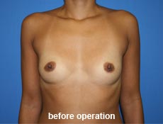 plastic-surgery-breast-augmentation
