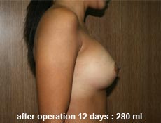 plastic-surgery-breast-augmentation