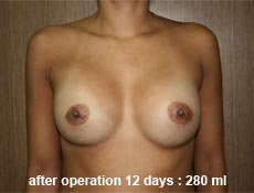 plastic-surgery-breast-augmentation