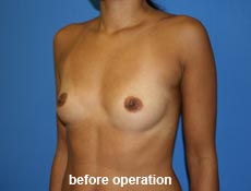 plastic-surgery-breast-augmentation