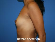 plastic-surgery-breast-augmentation