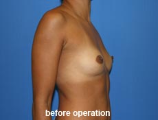 plastic-surgery-breast-augmentation