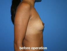 plastic-surgery-breast-augmentation