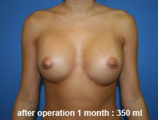 plastic-surgery-breast-augmentation