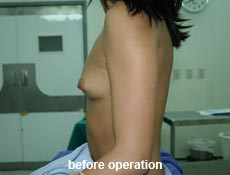 plastic-surgery-breast-augmentation