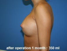 plastic-surgery-breast-augmentation
