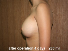 plastic-surgery-breast-augmentation