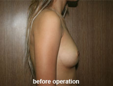 plastic-surgery-breast-augmentation