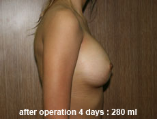 plastic-surgery-breast-augmentation