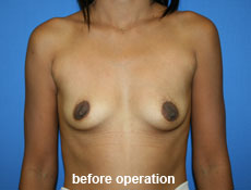plastic-surgery-breast-augmentation