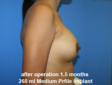 plastic-surgery-breast-augmentation