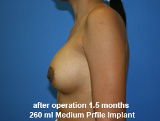 plastic-surgery-breast-augmentation