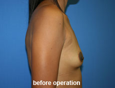 plastic-surgery-breast-augmentation