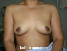 plastic-surgery-breast-augmentation