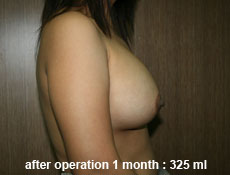 plastic-surgery-breast-augmentation
