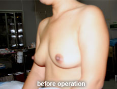plastic-surgery-breast-augmentation