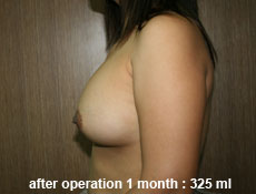 plastic-surgery-breast-augmentation