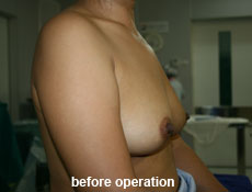 plastic-surgery-breast-augmentation