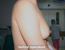 plastic-surgery-breast-augmentation