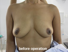 plastic-surgery-breast-augmentation