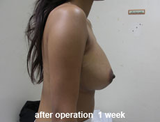 plastic-surgery-breast-augmentation